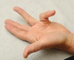 New treatment for Dupuytren's contracture reduces need for surgery 