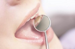 Dental Implants  
