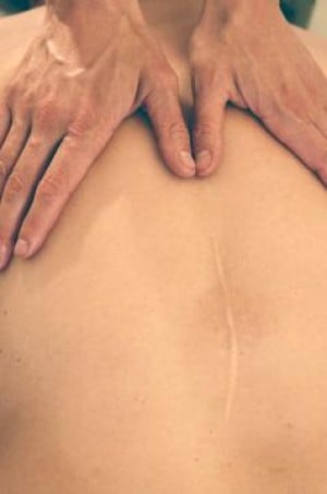 Scar Removal  