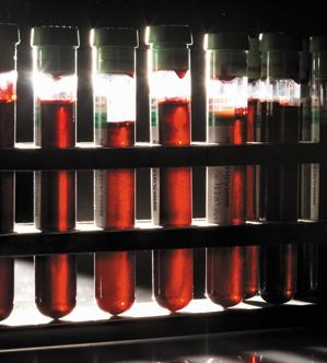 Ovarian Cancer Test