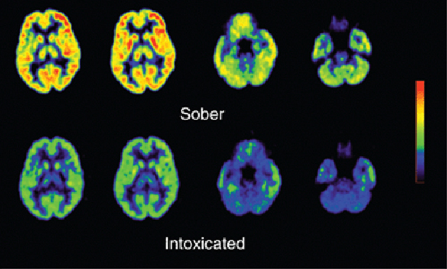 Can Excessive Drinking Cause Schizophrenia Can Excessive Drinking Cause Schizophrenia