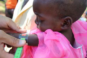 Study: Right gut bacteria might protect against malnutrition