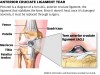 ACL injury