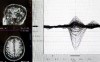 SLU brain damage study