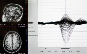 Studying brain activity in patients with traumatic brain injuries