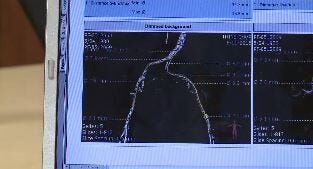 Surgery-Free Heart Valve Procedure