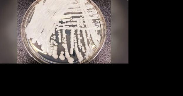 Nevada Has Most Superbug Fungus Infections, CDC Says - Vimarsana News