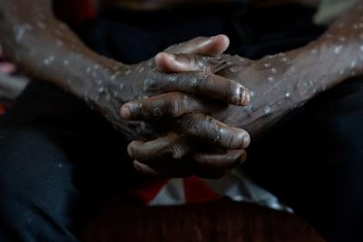 Congo-Mpox Outbreak