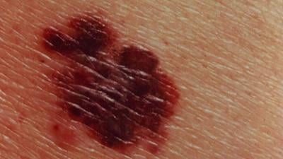 Skin Cancer Generic MGN.jpg