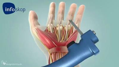 Carpal Tunnel Syndrome Surgery