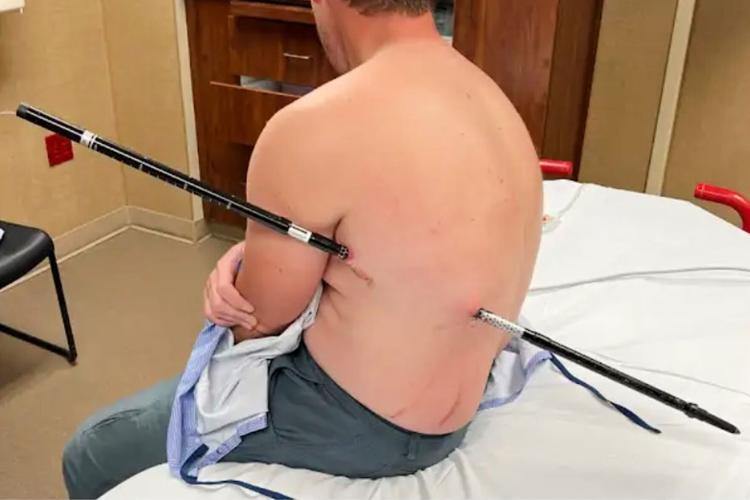 Impaled Hiker