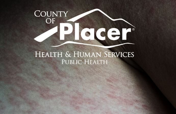 Placer County measles cases