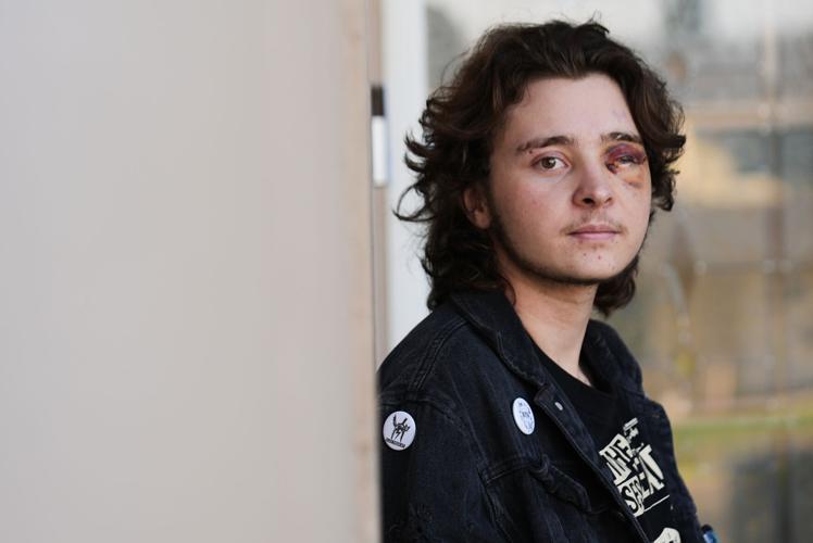 California Protester Injured