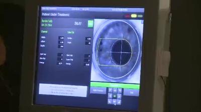 Kamra Inlay Device to Restore Near Vision