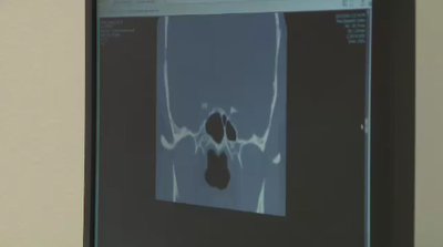 Childhood Injury Leads to Nose Surgery Decades Later