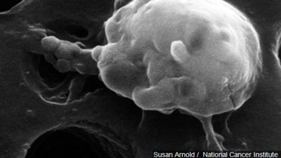 Cancer Now No. 1 Killer in 22 States, Ahead of Heart Disease