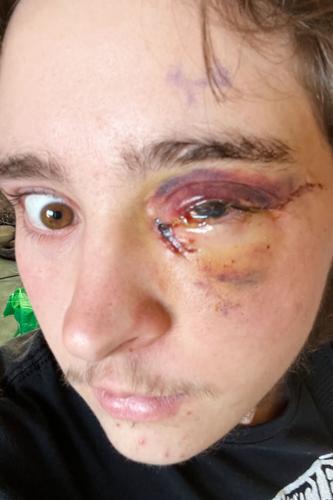 California Protester Injured