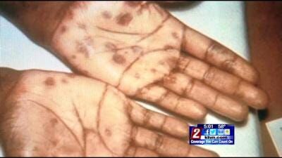 Syphilis Cases Rise in Washoe County