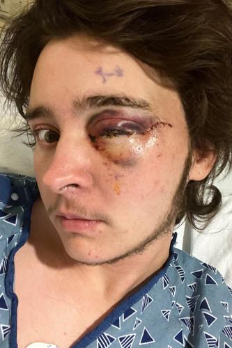 California Protester Injured