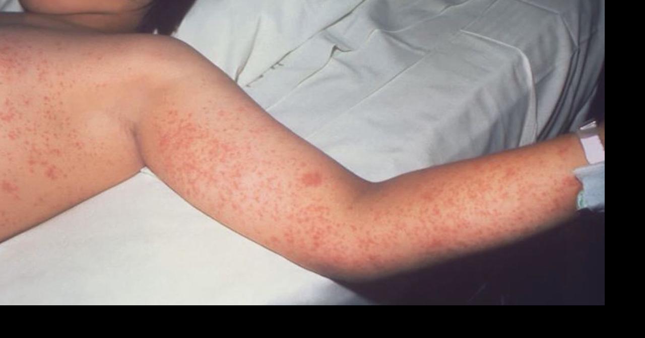 Measles cases rise: health alert for Michigan travelers