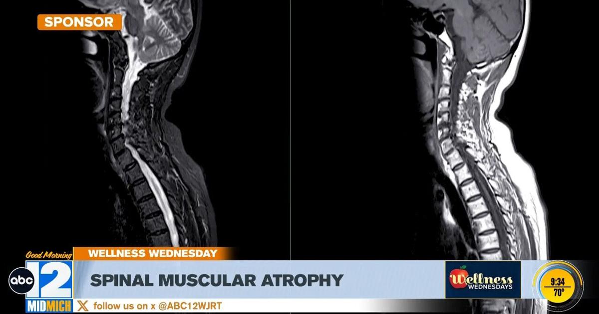 Wellness Wednesday: Spinal Muscular Atrophy | Good Morning Mid-Michigan ...