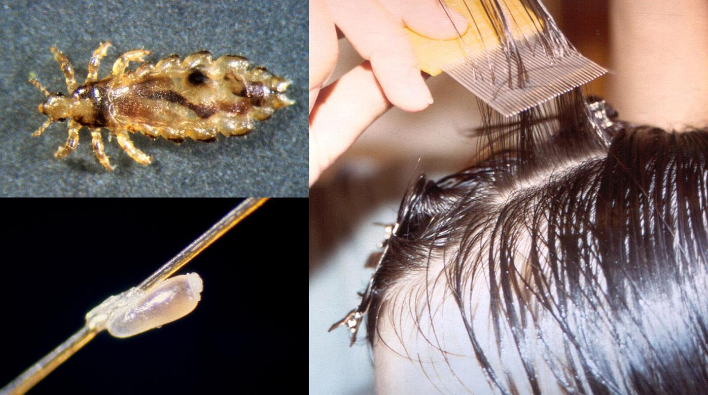 New guidance says children with head lice can stay in school | Health |  