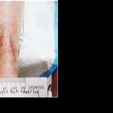 Wound care: Abilene's fast growing health facility — Wound Care clinic in Abilene, KS