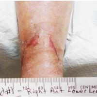 Wound care: Abilene's fast growing health facility — Wound Care clinic in Abilene, KS