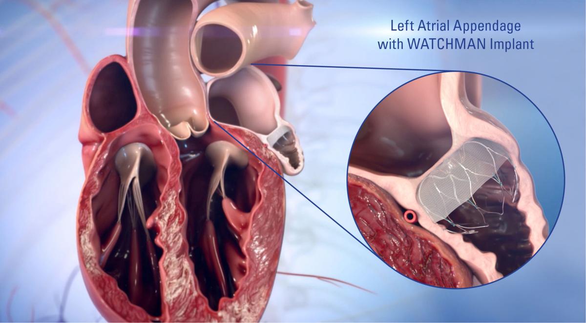 Watchman offers longterm solution for highrisk stroke, bleeding