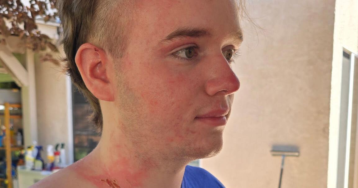 Upcoming comedy event in Yuba City supports Jacob Smith, victim of hot oil attack, who’s working to recover