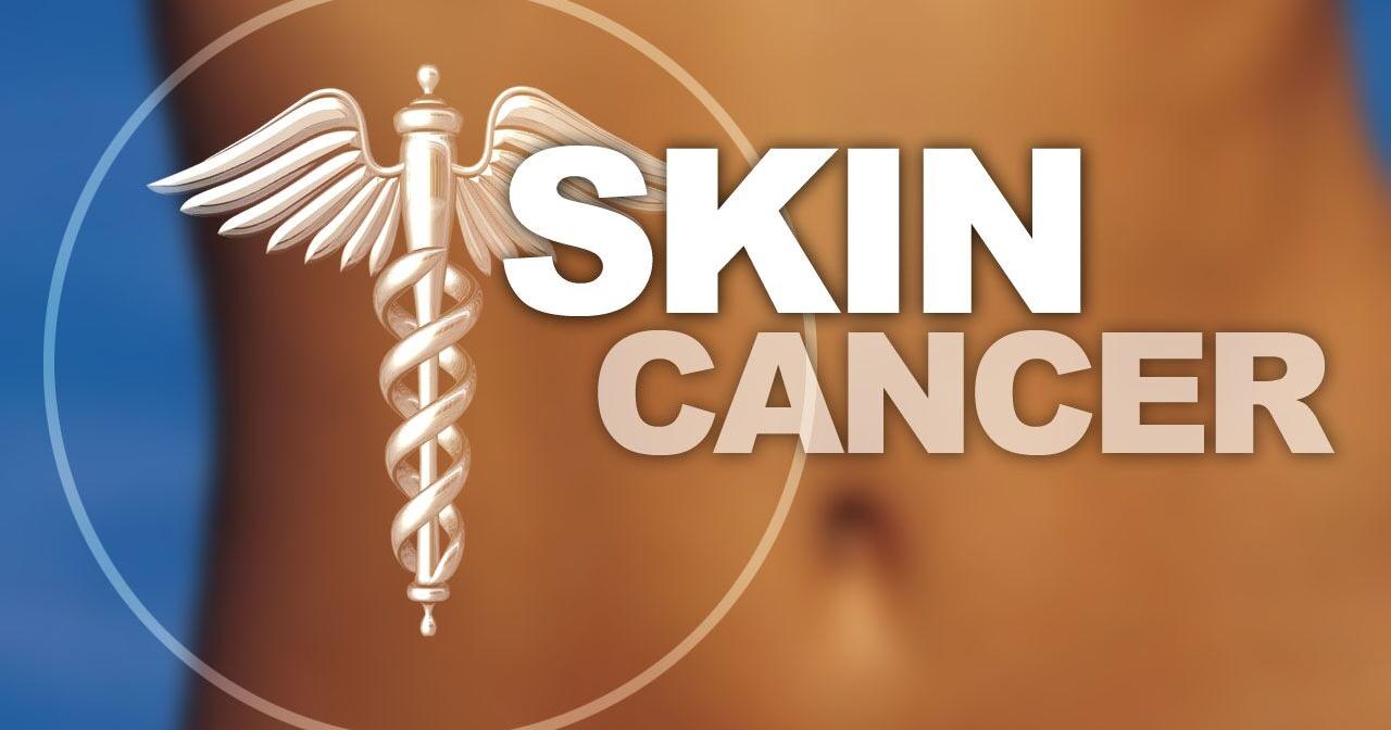 Free skin cancer screenings coming to Kennewick - Vimarsana News