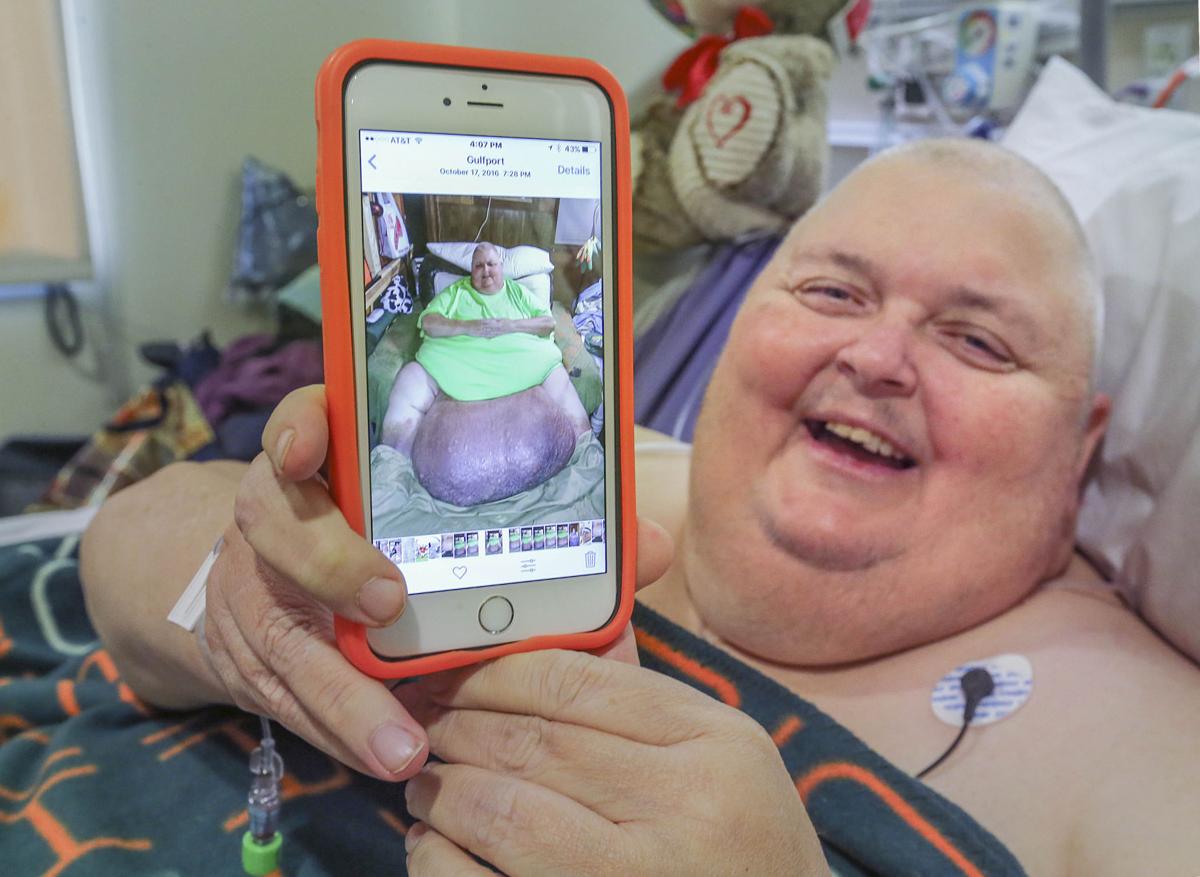 Man gains new life after losing 140pound tumor News