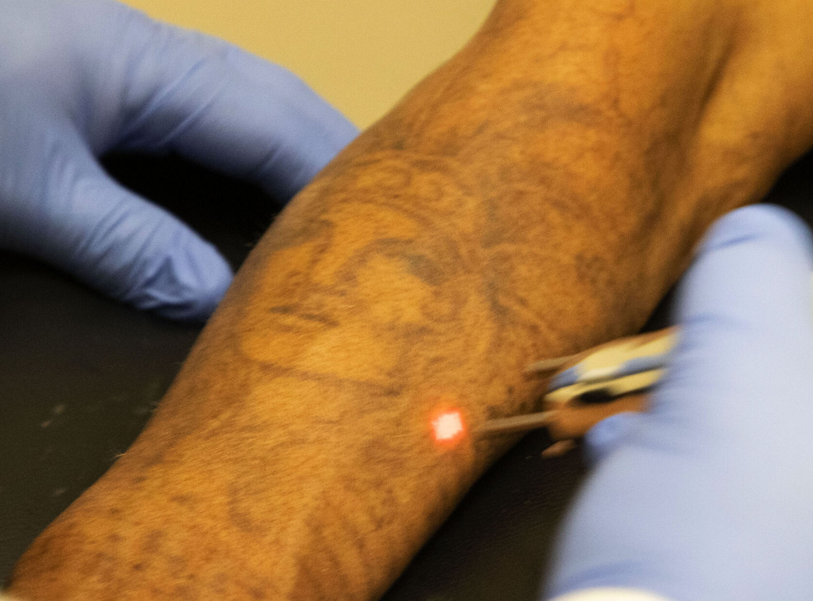 How Tattoo Removal Works  Silhouette Plastic Surgery Institute