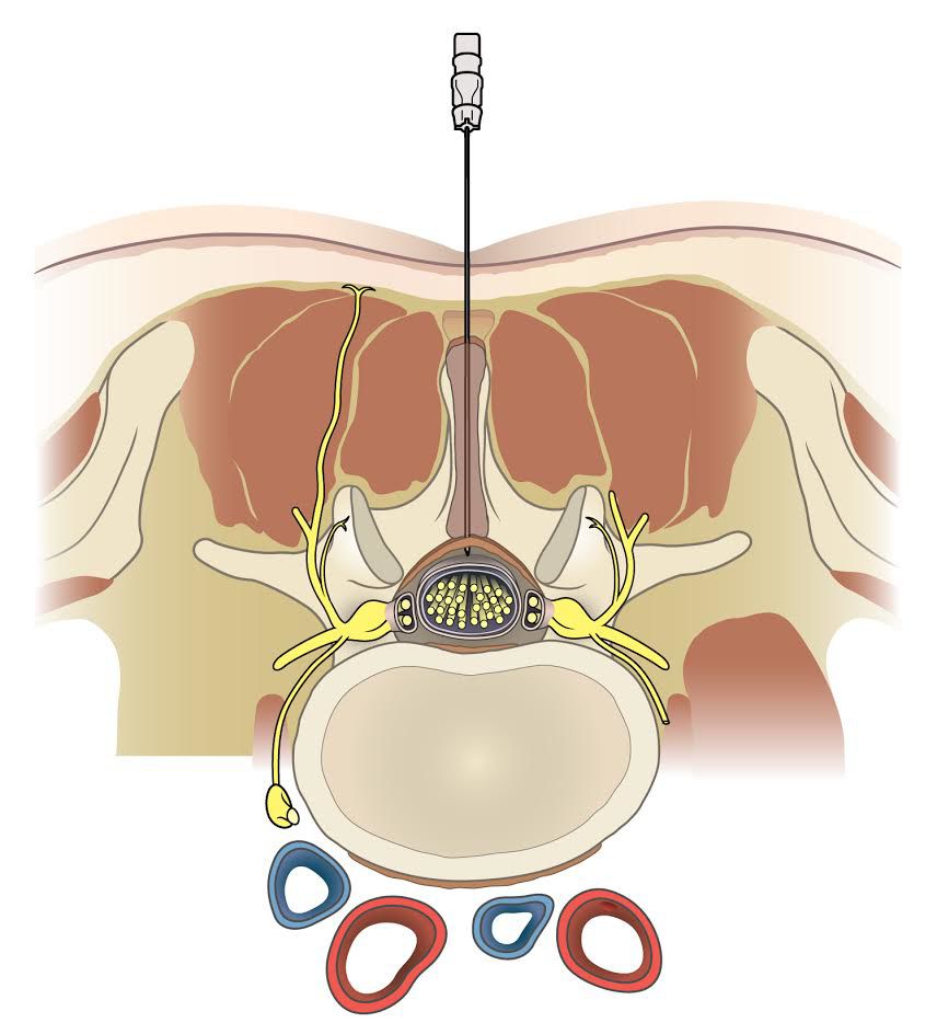 Medicaid Unlikely To Cover Back Pain Shots Health Bendbulletin Com