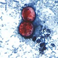 Berkshire health officials: No local cyclospora cases, but take precautions as outbreak grows