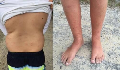 swimmers itch symptoms