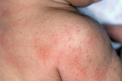 Prickly heat (heat rash)- Causes, home remedies and preventions