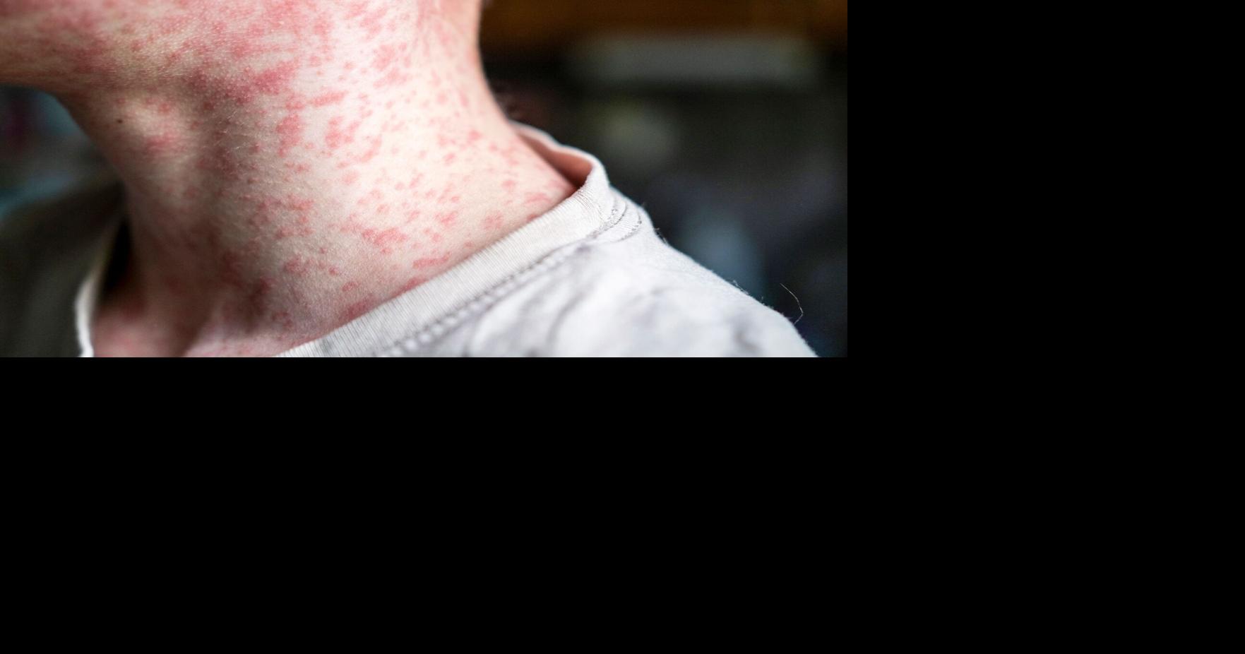 Measles outbreak in southwestern Wisconsin grows, 2 cases confirmed in Grant County - Channel 3000