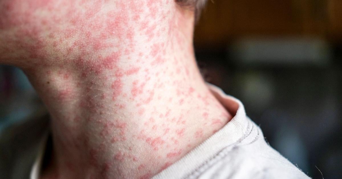 Measles outbreak in southwestern Wisconsin grows, 2 cases confirmed in Grant County - Channel 3000