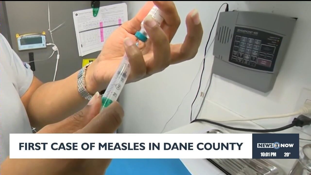 Measles Case Confirmed in Uw-madison Student