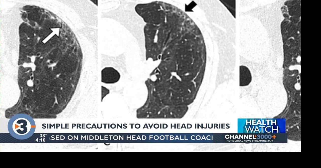 Simple precautions can prevent head injuries and concussions, UW Health