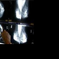 Mammograms should start at 40 to address rising breast cancer rates at younger ages, panel says - Vimarsana News