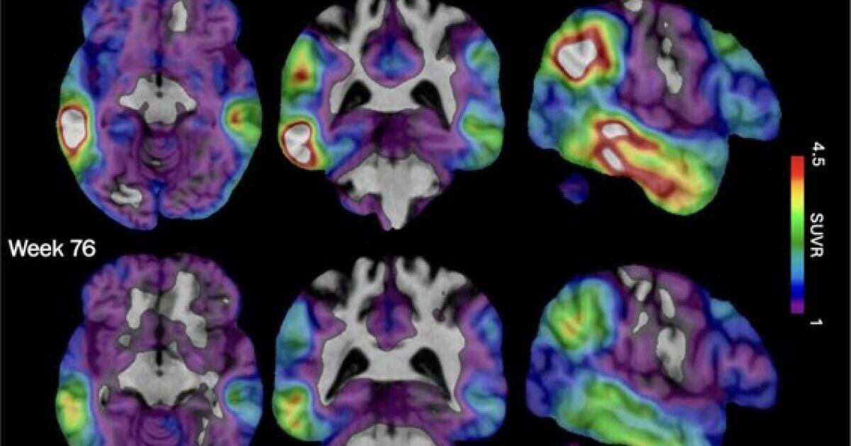 An experimental Alzheimer's drug shows some promise as researchers hunt new approaches