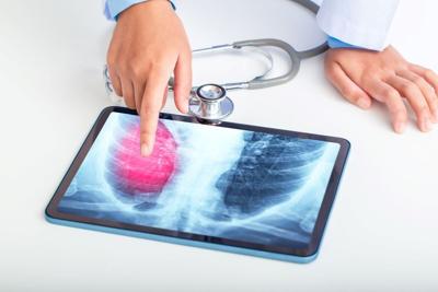 Early Steps to a Breath Test for Lung Cancer