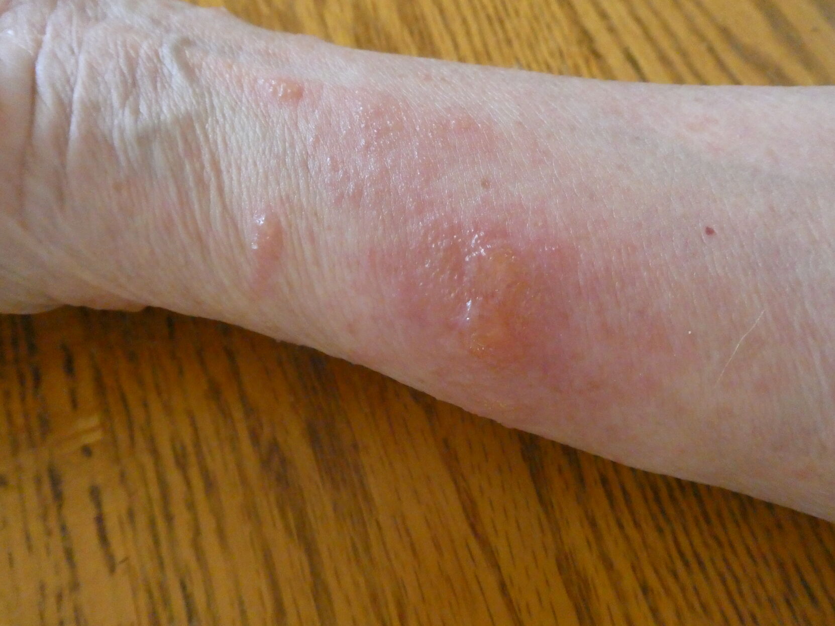 mild poison ivy rash