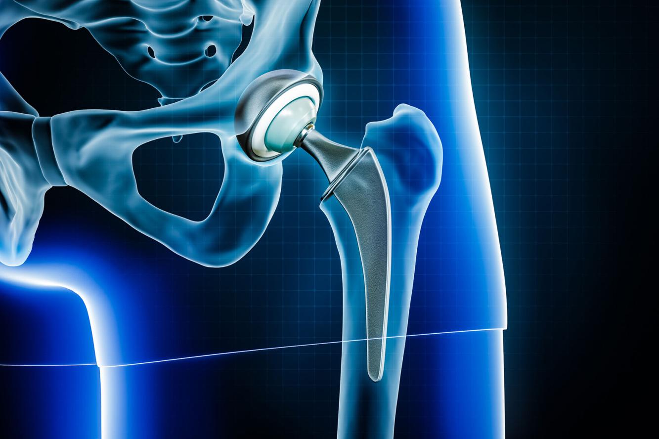 Physical therapy plays a crucial role in hip replacement postop care