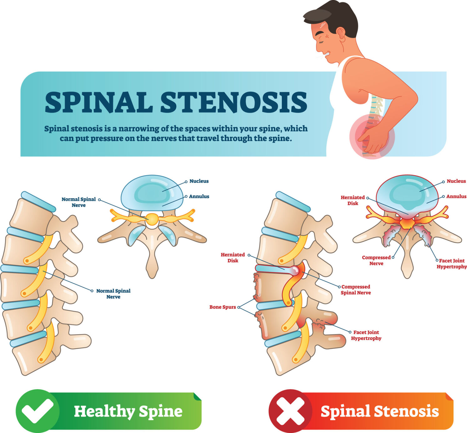 Spinal Stenosis Could Be Causing Your Walking Problems | Cairo S Corner ...