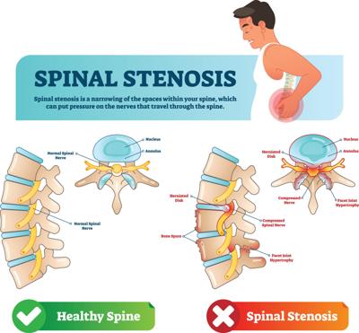 Spinal Stenosis graphic
