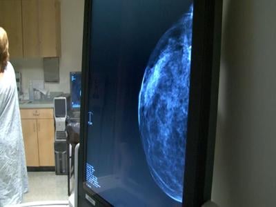 New Guideline Says Women Need Breast Cancer Screenings at Age 40