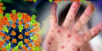 Spotted hand and measles molecule.